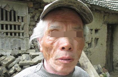 武汉中老年人白癜风如何能治疗好?