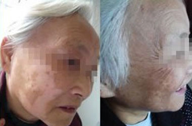 武汉白癜风医院医生谈老年人护理白癜风的办法