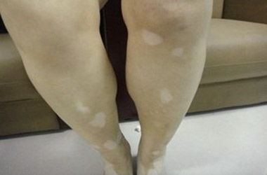 武汉患者腿部患白癜风的病因是什么呢?